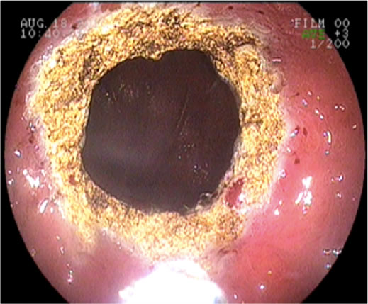 Plasma de Argônio - Dr. João Henrique Felício em Curitiba