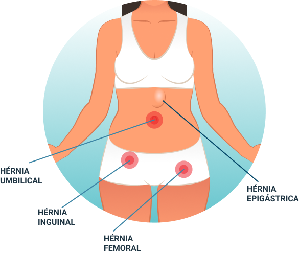 TRATAMENTO - HÉRNIA INGUINAL - Dr. João Henrique